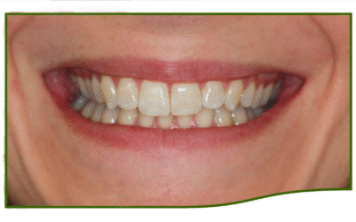 Tandblegning hos tandlægen